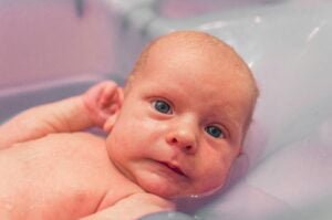 Read more about the article What Is Cradle Cap In Babies Caused By?
